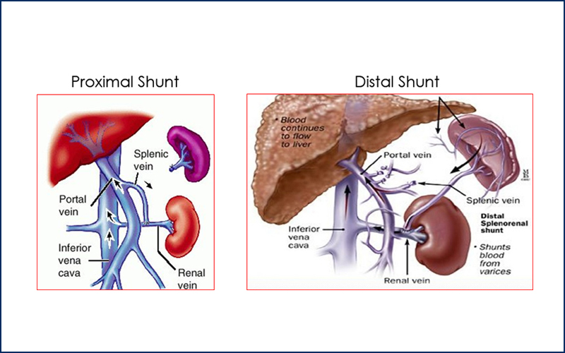 splenorenal shunt